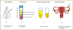 PRP in IVF treatment